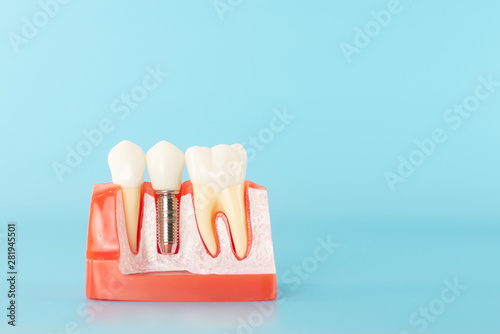 Dental implant model on blue background.