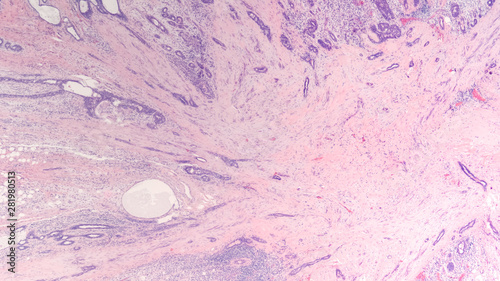 Radial scar of the breast is a benign lesion that can mimic cancer both by radiology and histology and may be associated with cancer in up to 30% of cases. 