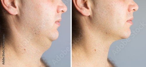 Man before and after double chin fat correction procedure