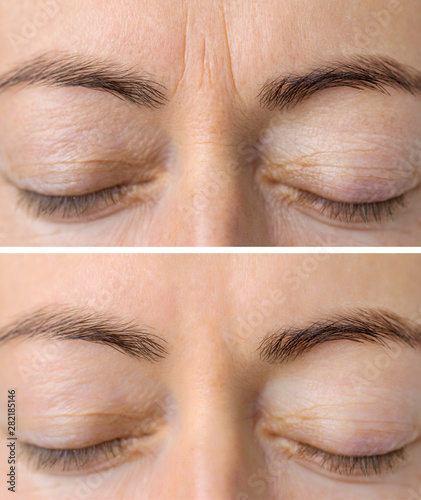 Woman's face skin before and after aesthetic beauty cosmetic procedures with removed skin wrinkles