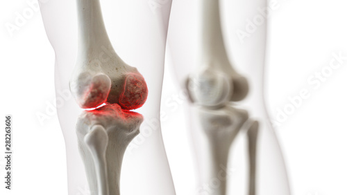 3d rendered medically accurate illustration of an arthritic knee joint