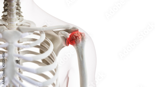 3d rendered medically accurate illustration of an arthritic shoulder joint