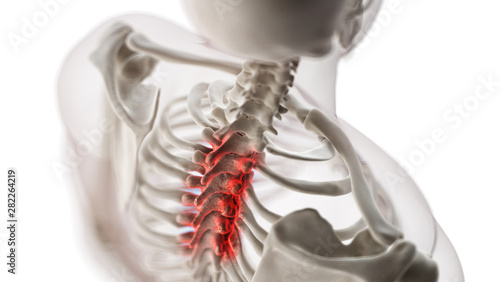 3d rendered medically accurate illustration of an arthritic thoracic spine