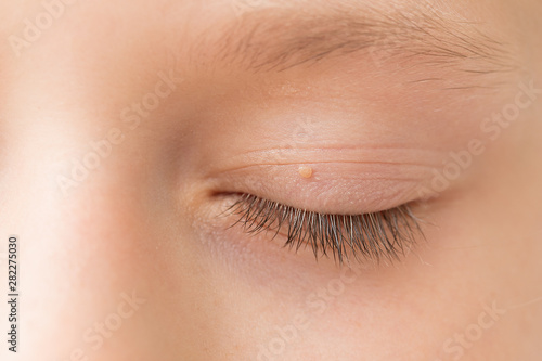 Close up of wart on eyelid. Young girl with papillomas on skin around eye, macro