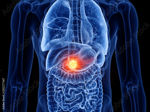 3d rendered medically accurate illustration of pancreas cancer