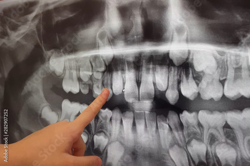 X-RAY PICTURE OF DAIRY AND NEW CHILDRENS TEETH.