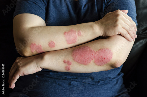 Dermatological skin disease. psoriasis, eczema, dermatitis, allergies. Skin lesions on the elbows.