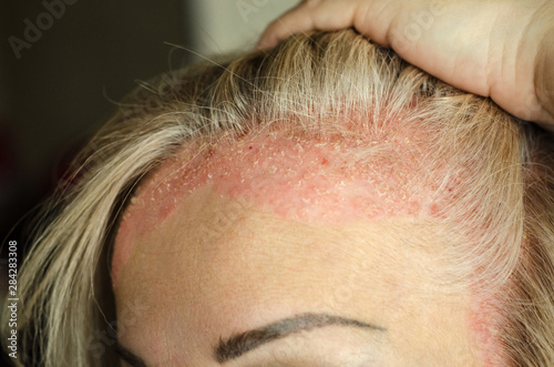 Dermatological skin disease. psoriasis, eczema, dermatitis, allergies. Skin lesions on the head.