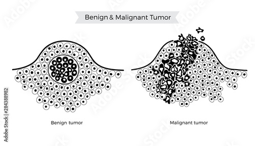 Vector illustration of malignant and benign tumor