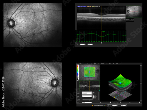 Ophthalmic test - OCT optical coherence tomography measurement. Scan of the macula in retina, layers and thickness of retina.