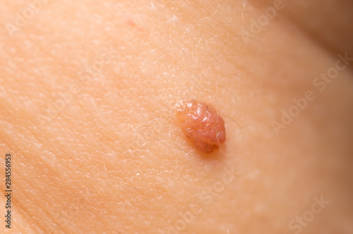 Macro of Papillomas or mole on female neck close up background