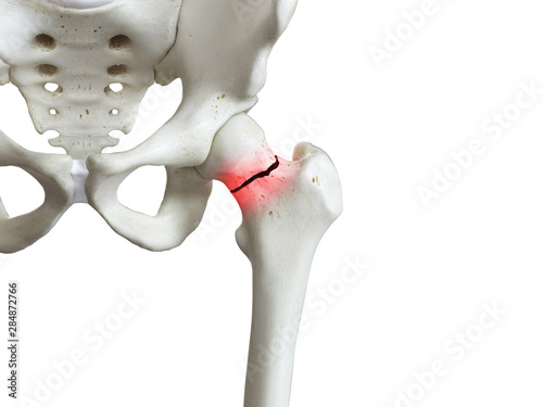 3d rendered medically accurate illustration of a broken femur neck