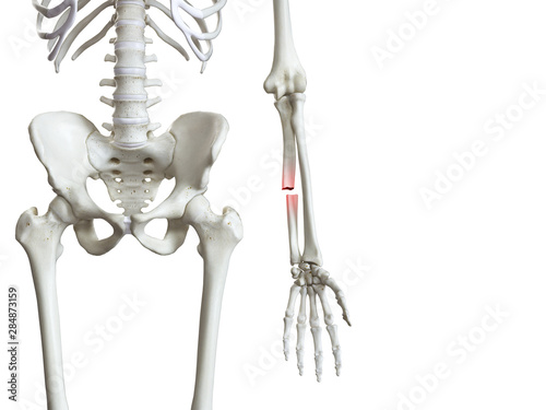 3d rendered medically accurate illustration of a broken ulna