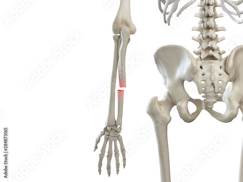 3d rendered medically accurate illustration of a broken ulna