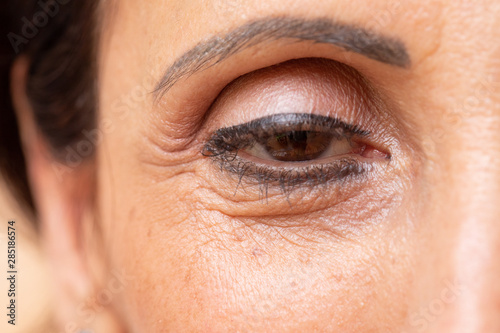 Extreme close up of female eye with drooping eyelid, amblyopia condition called lazy eye.