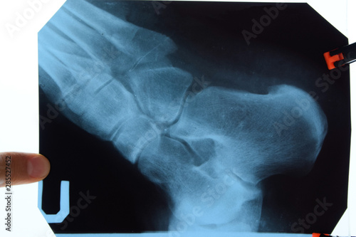 X-ray of feet and heel bones. X ray picture of bones.