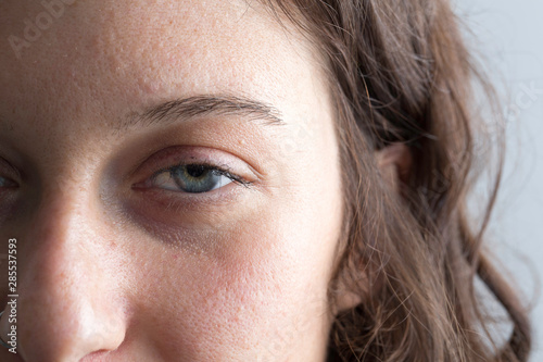 Close up of woman face showing eye affected of drooping eyelid after botox treatment