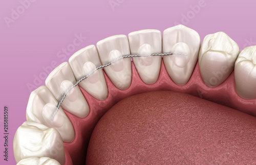 Retainers dental installed after braces treatment, Medically accurate dental 3D illustration