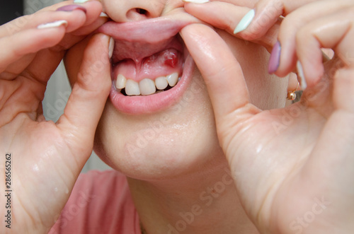 Close-up of gum with cyst or purulent flux. Disease of the gums and teeth.