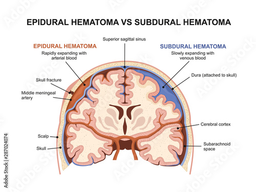 Epidural hematoma vs subdural hematoma