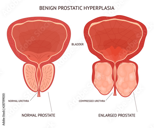 Cartoon Benign Prostatic Hyperplasia Infographics Concept Card Poster. Vector