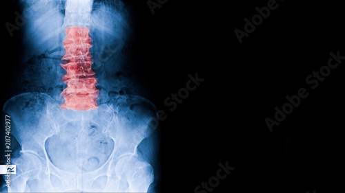 X-ray image elderly people have low back pain X-ray show lumbar spine spondylosis means degenerative changes of spine in old age.