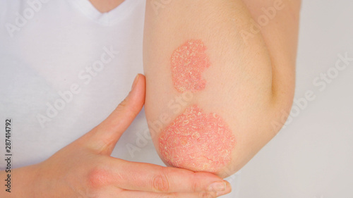 CLOSE UP Woman with big red scaly rash suffering from elbow psoriatic arthritis