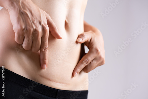 Closeup of woman showing on her belly dark scar from a cesarean section. Healthcare concept.