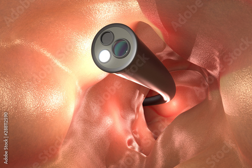 Colonoscopy technology concept