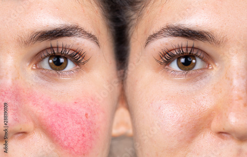 Before and after successful rosacea treatment on the face of a caucasian lady. Redness and visible blood vessels are all removed through laser surgery.