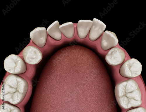 Abnormal teeth position, orthodontic concept. Medically accurate tooth 3D illustration