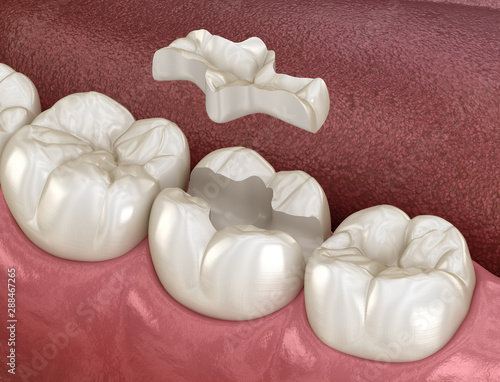 Inlay ceramic crown fixation over tooth. Medically accurate 3D illustration of human teeth treatment