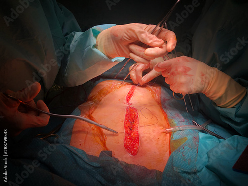 Laparotomy the process of peritoneal incision. Operating room undergoing surgery. Health care and medical concept