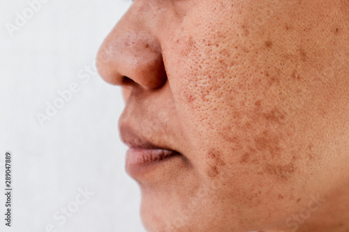 Skin problem, skin face asian women with spot melasma, Dark spots, freckles, pigmentation Skincare problem concept.