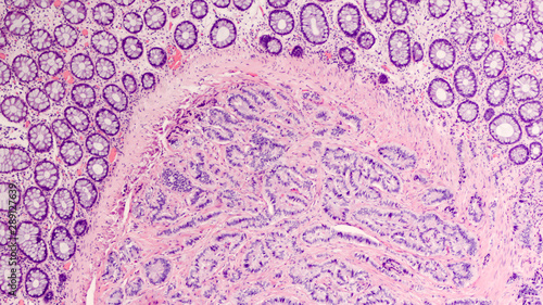 Photomicrograph of a carcinoid tumor, a type of neuroendocrine tumor (NET), which presented as a colon polyp during routine colonoscopy. Spread to liver can cause symptoms of carcinoid syndrome.