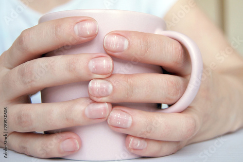 Many white spots on fingernails ( Leukonychia ) due to calcium deficit or stress. Female hands holding mug