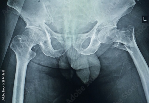X-ray both hip : A male 68 year old fracture left Neck of femur ( Thigh bone )