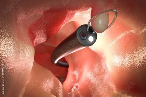 endoscope remove colonic polyp