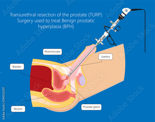 Transurethral resection of the prostate stricture urine bladder digital rectal exam specific antigen Gleason score biopsies Prostatitis test blood ultrasonography Radical Prostatectomy