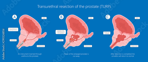 Transurethral resection of the prostate stricture urine bladder digital rectal exam specific antigen Gleason score biopsies Prostatitis test blood ultrasonography Radical Prostatectomy