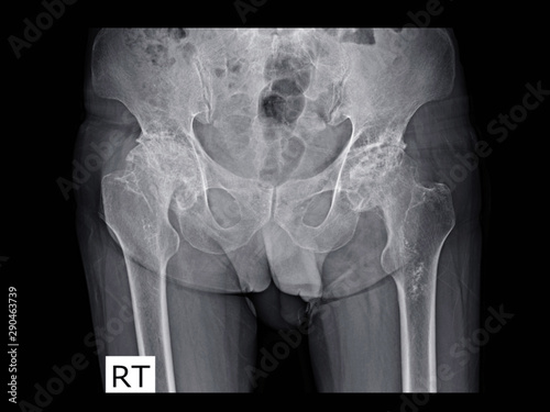 Film x-ray hip radiograph show femoral head collapse form bone infarction or avascular necrosis (AVN) or Osteonecrosis (ON) disease. Medical imaging concept