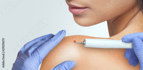 A beautician removes a large ugly mole from a woman’s shoulder.