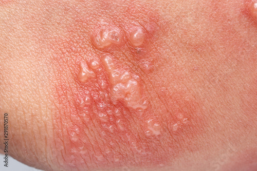 Shingles, Zoster or Herpes Zoster symptoms on arm