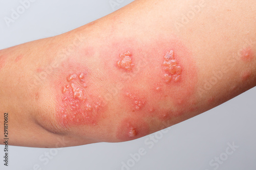 Shingles, Zoster or Herpes Zoster symptoms on arm