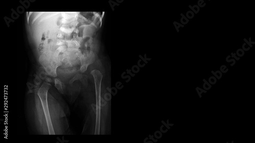 Film X ray hip radiograph show congenital developmental dysplasia of left hip(DDH) disease with hip joint subluxation. The patient has hip pain, limping and walking problem. Medical technology concept