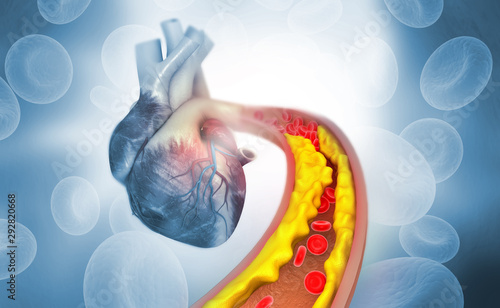 Cholesterol plaque in artery with Human heart anatomy. 3d illustration