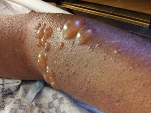 Bullous pemphigoid thick walled blisters with clear fluid