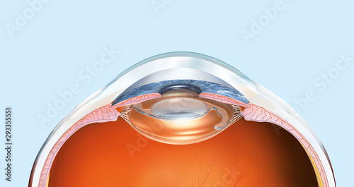 Human eye with artificial lens, lmedically 3D illustration
