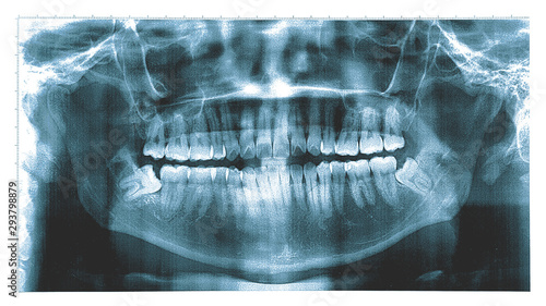 X-ray of a human jaw , Panoramic dental X-Ray from a mouth with some tooth wisdom tooth crashed into a molar.