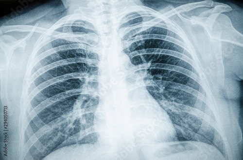 Radiographic image of the respiratory tract, lungs, ribs